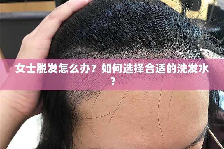 女士脱发怎么办？如何选择合适的洗发水？