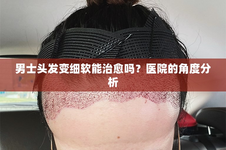 男士头发变细软能治愈吗？医院的角度分析