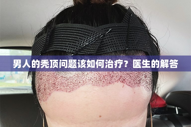 男人的秃顶问题该如何治疗？医生的解答