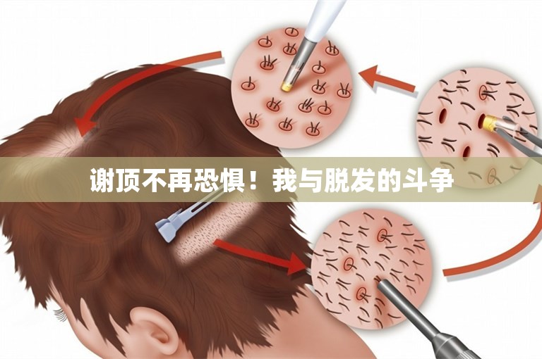 谢顶不再恐惧！我与脱发的斗争