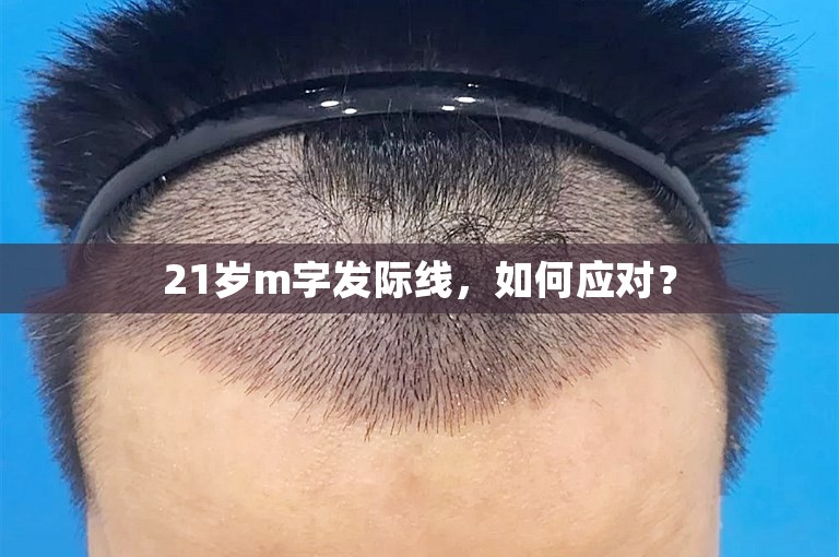 21岁m字发际线，如何应对？