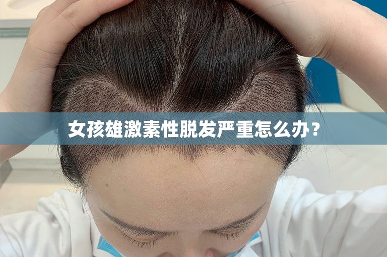 女孩雄激素性脱发严重怎么办？