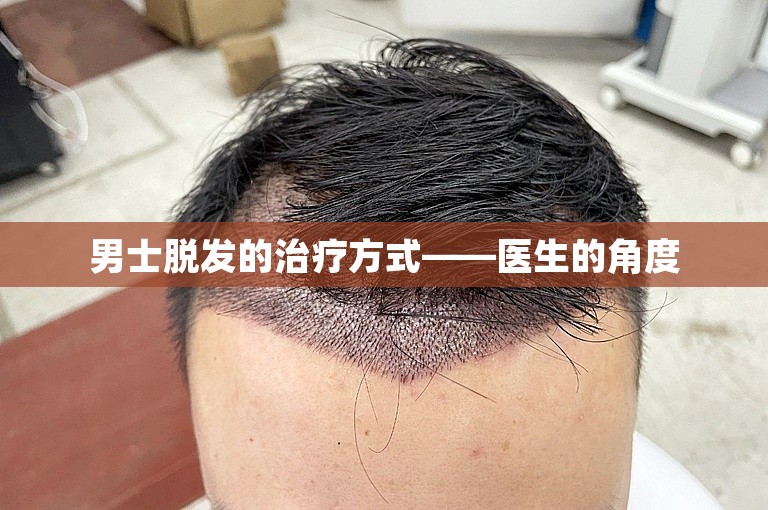 男士脱发的治疗方式——医生的角度