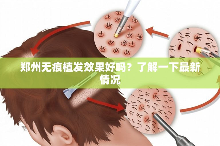 郑州无痕植发效果好吗？了解一下最新情况