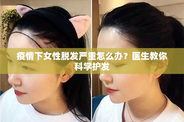 疫情下女性脱发严重怎么办？医生教你科学护发