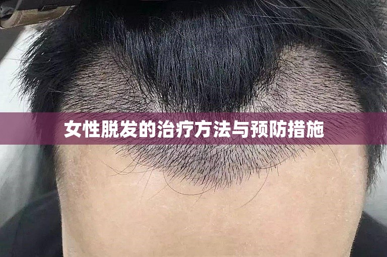 女性脱发的治疗方法与预防措施