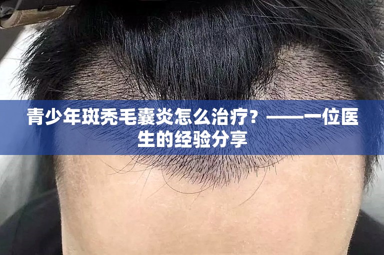 青少年斑秃毛囊炎怎么治疗？——一位医生的经验分享