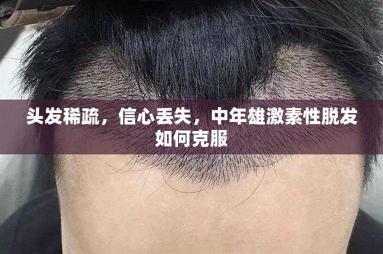 头发稀疏，信心丢失，中年雄激素性脱发如何克服