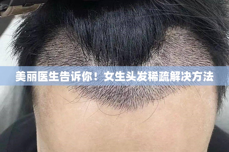 美丽医生告诉你！女生头发稀疏解决方法