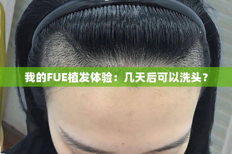 我的FUE植发体验：几天后可以洗头？