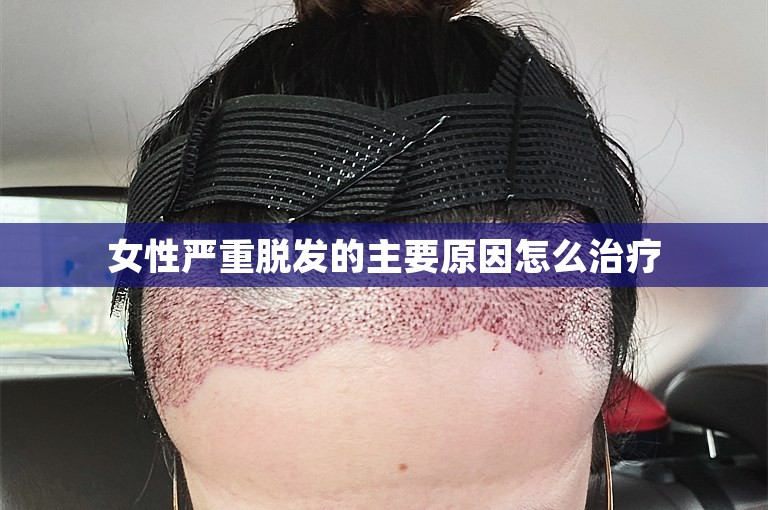 女性严重脱发的主要原因怎么治疗