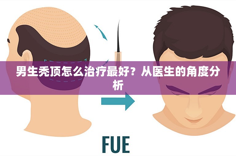 男生秃顶怎么治疗最好？从医生的角度分析