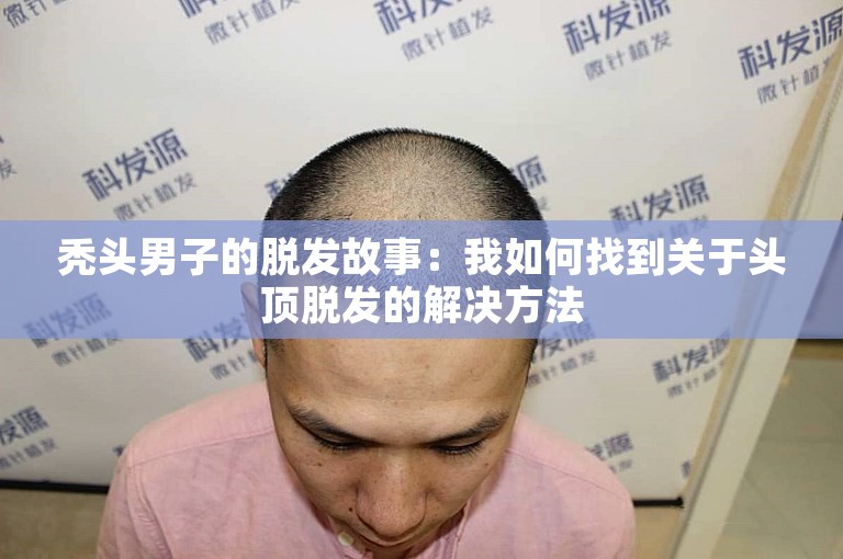 秃头男子的脱发故事：我如何找到关于头顶脱发的解决方法