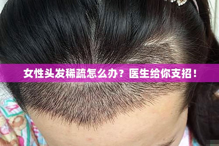 女性头发稀疏怎么办？医生给你支招！