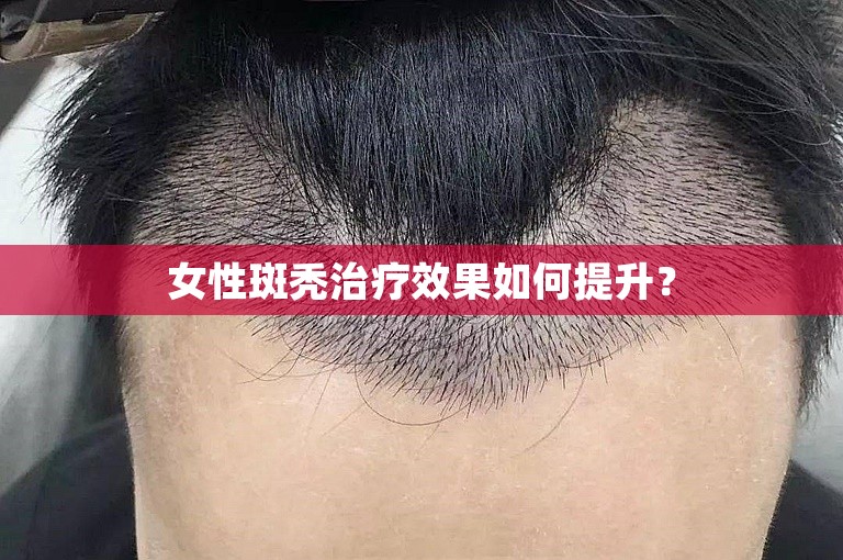 女性斑秃治疗效果如何提升？