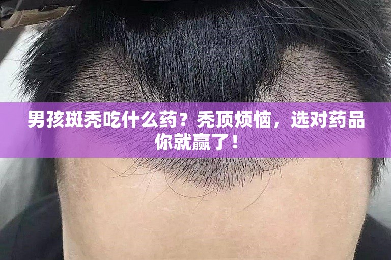 男孩斑秃吃什么药？秃顶烦恼，选对药品你就赢了！