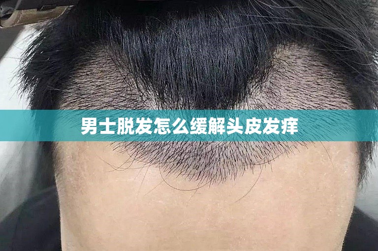 男士脱发怎么缓解头皮发痒