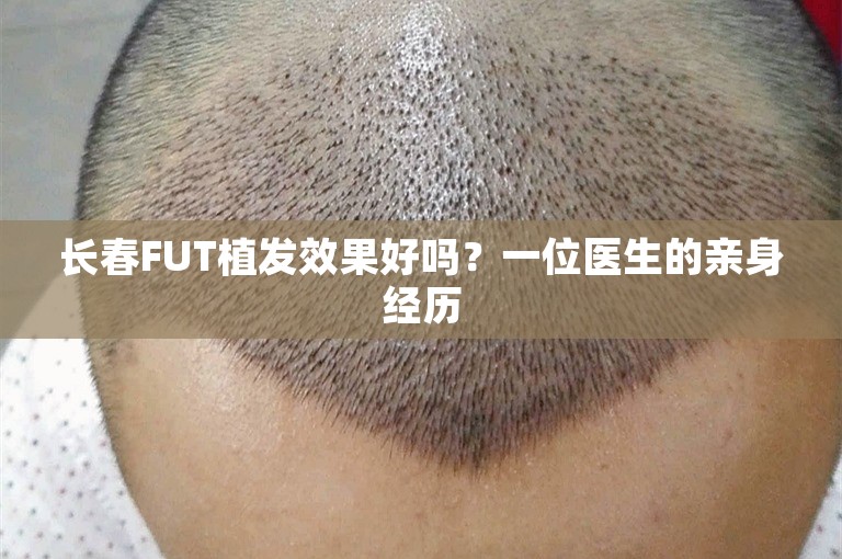 长春FUT植发效果好吗？一位医生的亲身经历