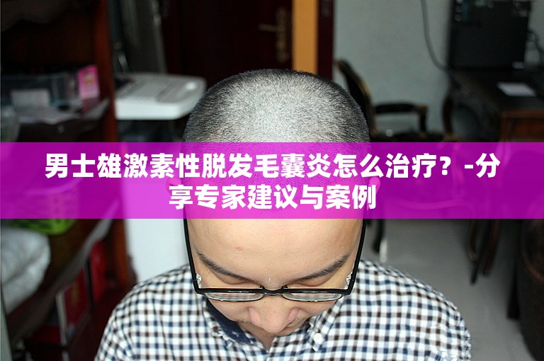 男士雄激素性脱发毛囊炎怎么治疗？-分享专家建议与案例