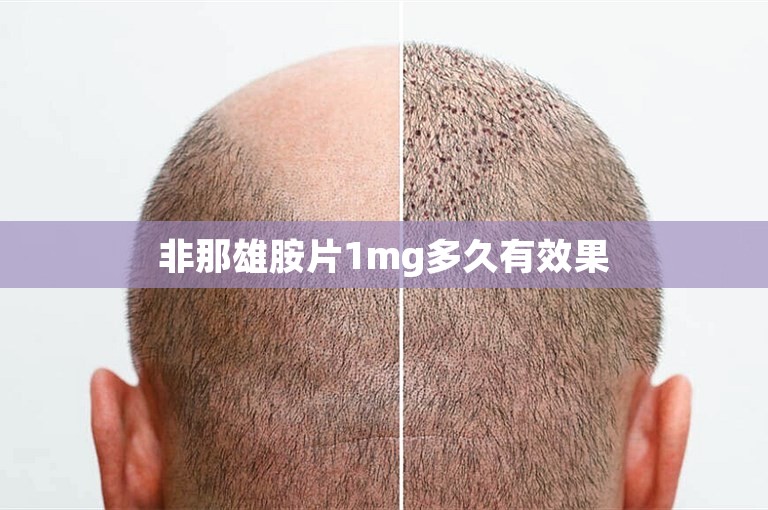 非那雄胺片1mg多久有效果