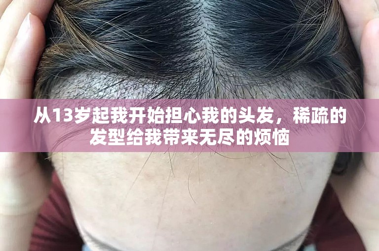 从13岁起我开始担心我的头发，稀疏的发型给我带来无尽的烦恼