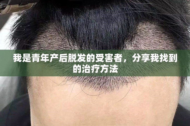 我是青年产后脱发的受害者，分享我找到的治疗方法