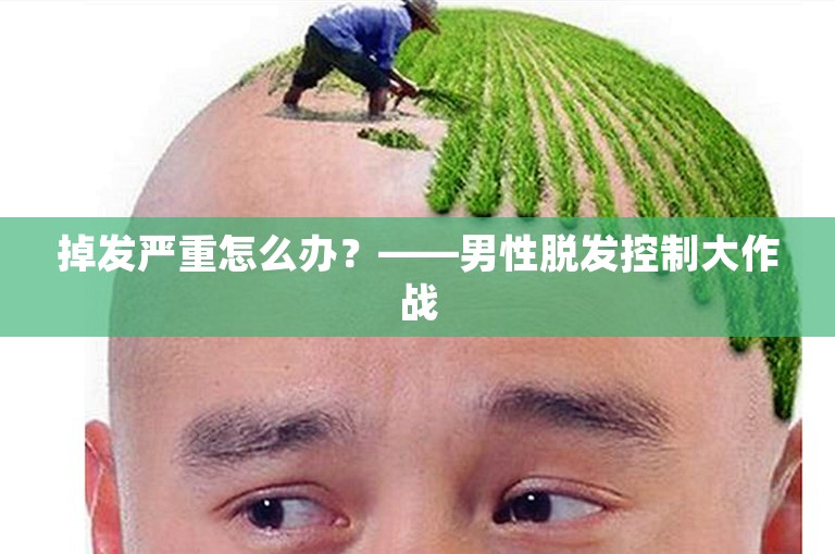 掉发严重怎么办？——男性脱发控制大作战