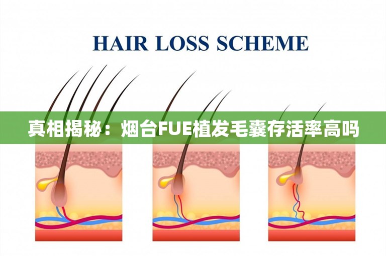 真相揭秘：烟台FUE植发毛囊存活率高吗