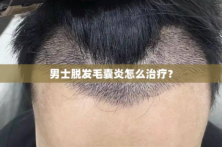 男士脱发毛囊炎怎么治疗？