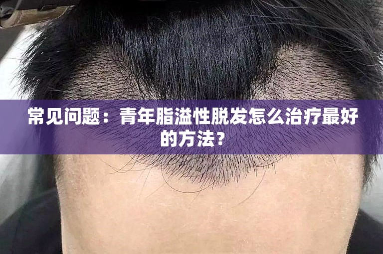 常见问题：青年脂溢性脱发怎么治疗最好的方法？