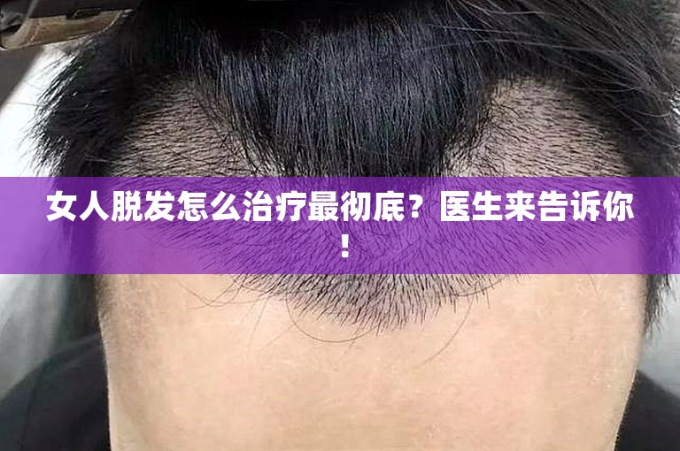 女人脱发怎么治疗最彻底？医生来告诉你！