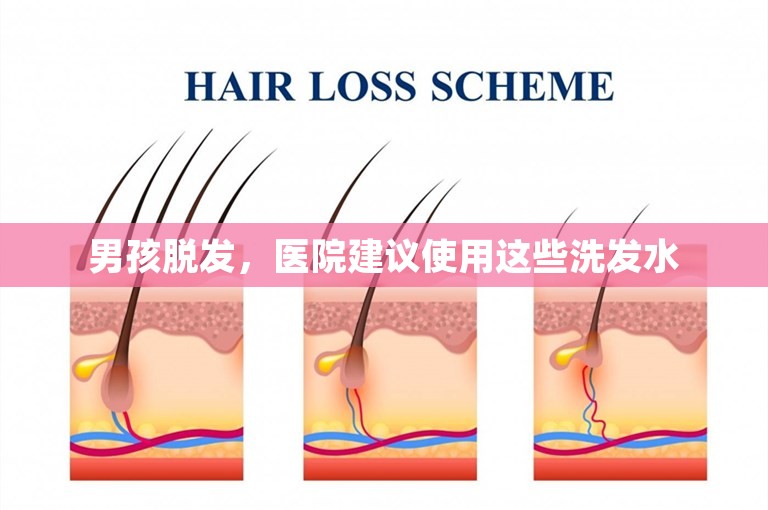 男孩脱发，医院建议使用这些洗发水