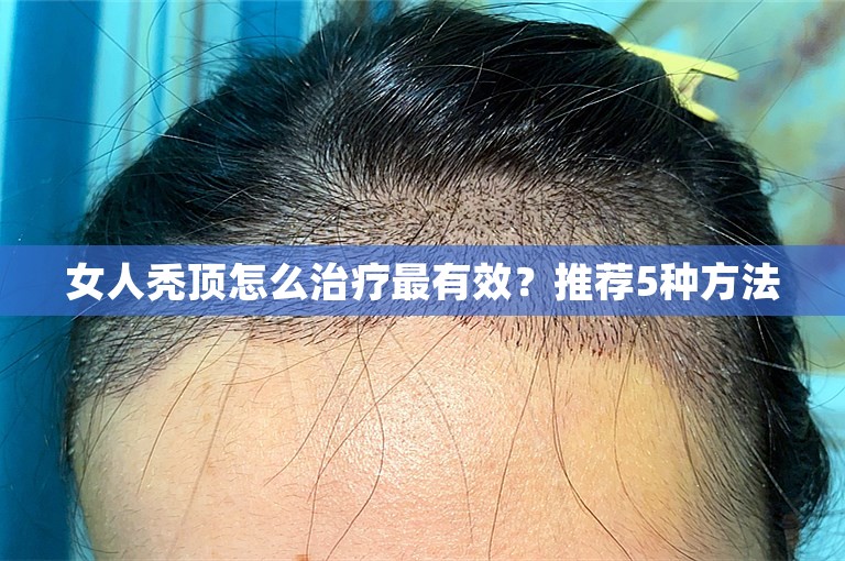 女人秃顶怎么治疗最有效？推荐5种方法