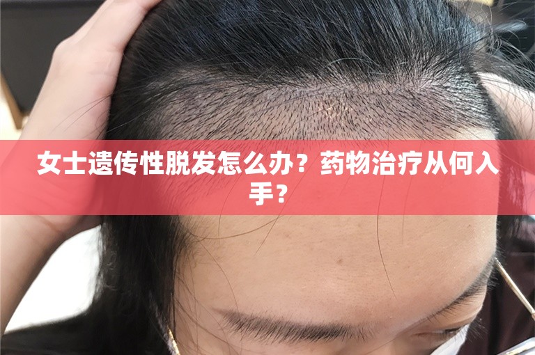 女士遗传性脱发怎么办？药物治疗从何入手？