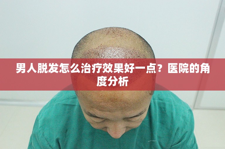 男人脱发怎么治疗效果好一点？医院的角度分析