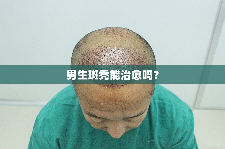 男生斑秃能治愈吗？