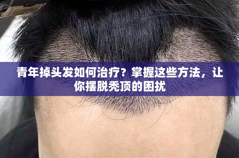 青年掉头发如何治疗？掌握这些方法，让你摆脱秃顶的困扰