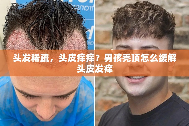 头发稀疏，头皮痒痒？男孩秃顶怎么缓解头皮发痒