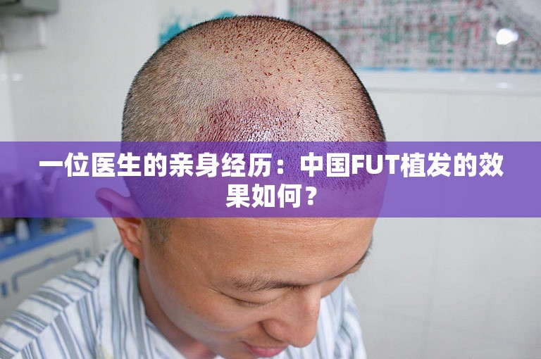 一位医生的亲身经历：中国FUT植发的效果如何？