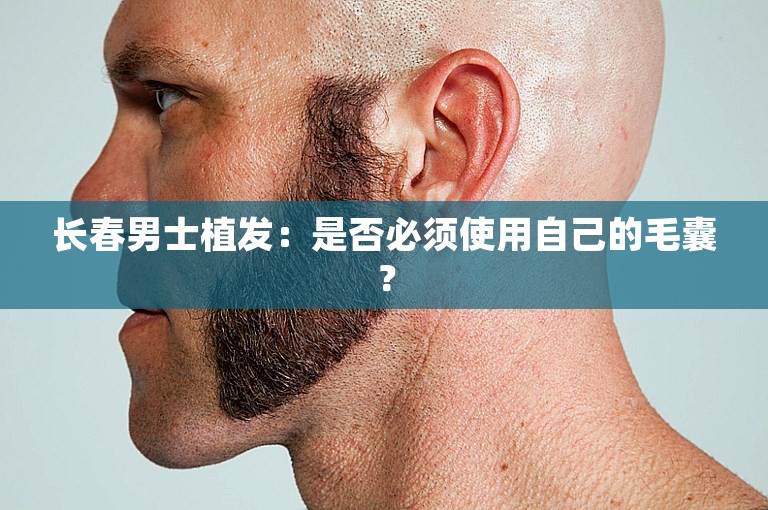 长春男士植发：是否必须使用自己的毛囊？