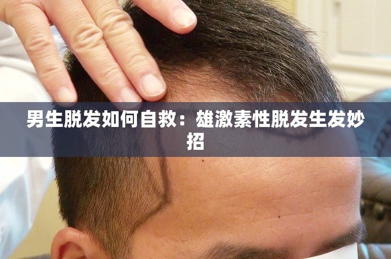 男生脱发如何自救：雄激素性脱发生发妙招