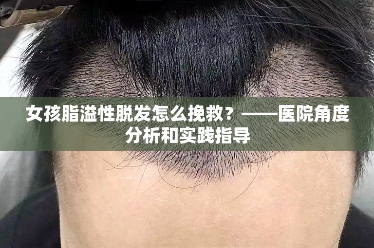 女孩脂溢性脱发怎么挽救？——医院角度分析和实践指导