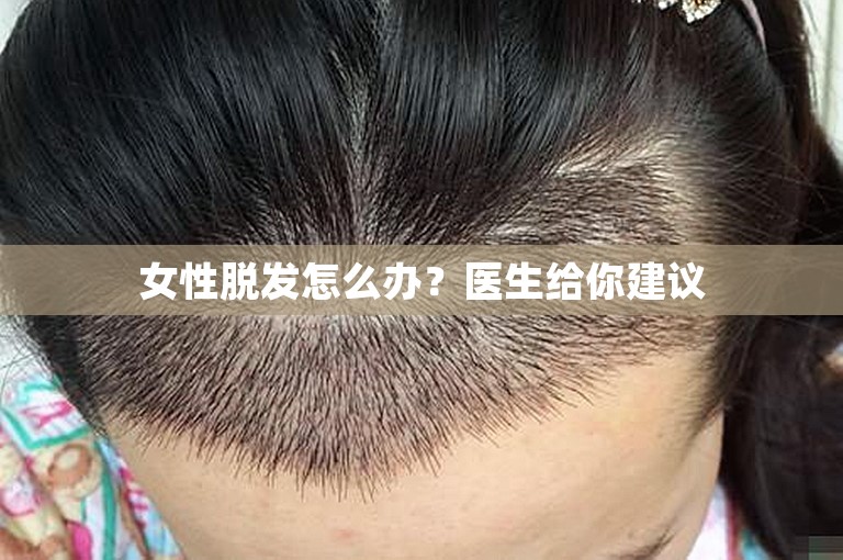 女性脱发怎么办？医生给你建议