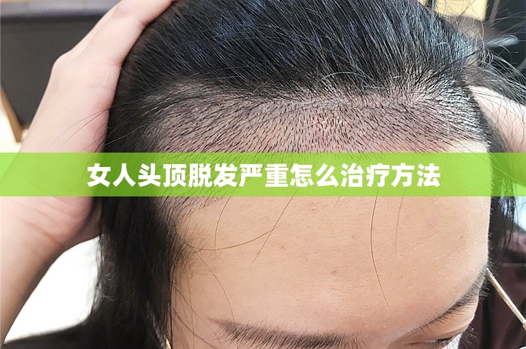 女人头顶脱发严重怎么治疗方法