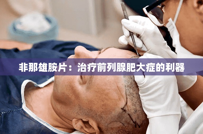 非那雄胺片：治疗前列腺肥大症的利器