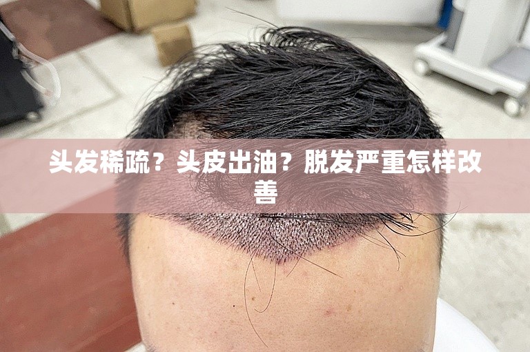 头发稀疏？头皮出油？脱发严重怎样改善