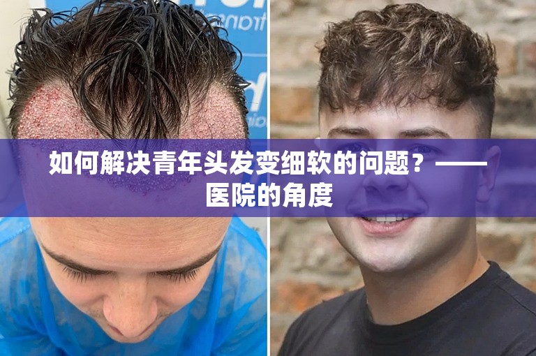 如何解决青年头发变细软的问题？——医院的角度