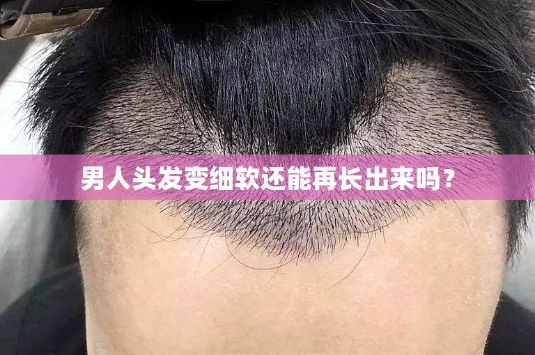 男人头发变细软还能再长出来吗？