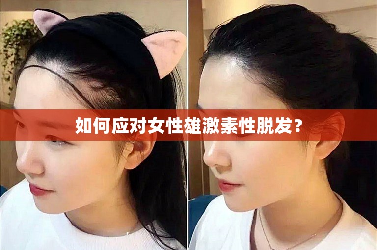 如何应对女性雄激素性脱发？