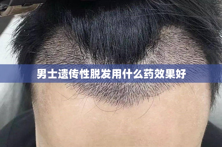 男士遗传性脱发用什么药效果好